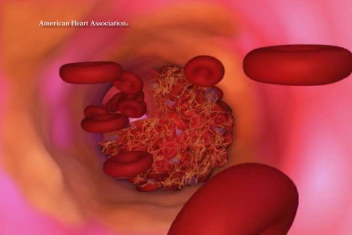 Persistent asthma linked to increased buildup of plaque in arteries leading to the brain