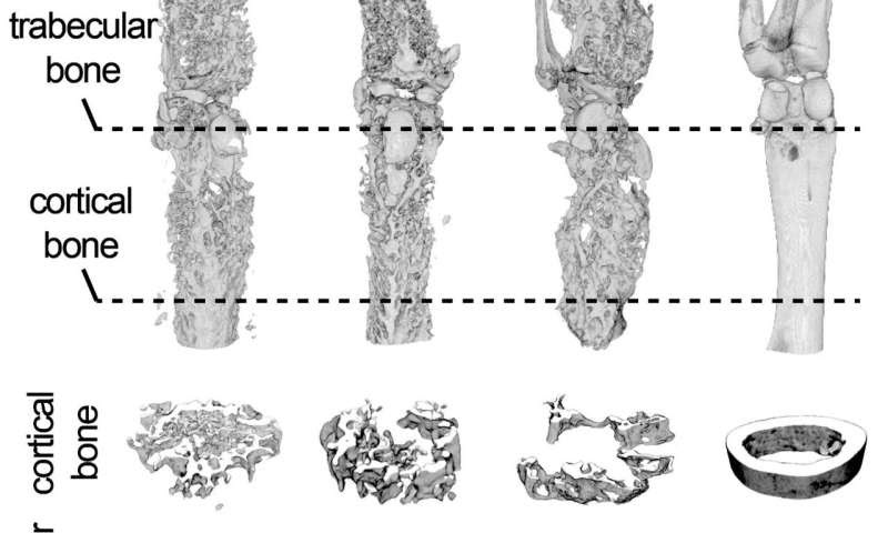 Drug doubles down on bone cancer, metastasis