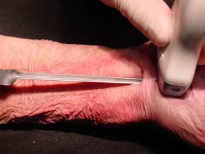 Imagen de Operación Percutánea del Síndrome del Túnel Carpiano bajo Control Ecográfico, por parte del Dr. Javier De la Fuente traumatólogo de la unidad de ecografía musculoesquelética del centro médico Sendagrup de Donostia - San Sebastián