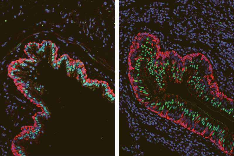 Molecular analysis identifies key differences in lungs of cystic fibrosis patients