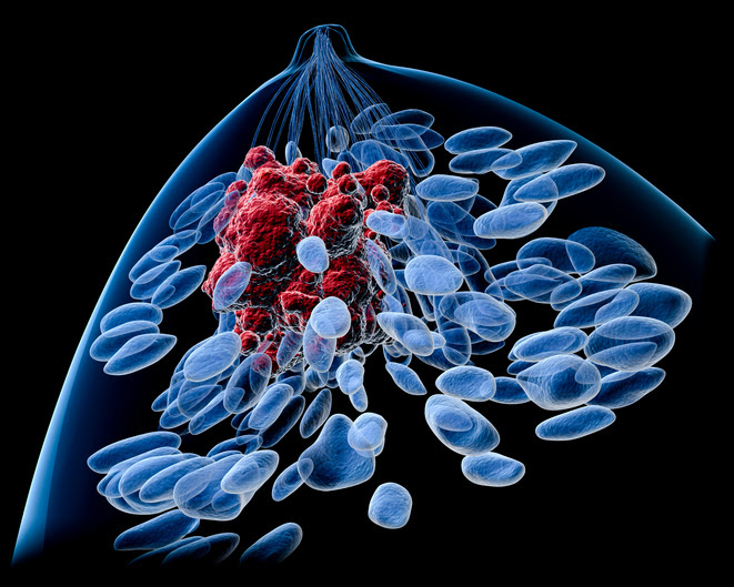 ilustracion de una mama con celulas cancerigenas