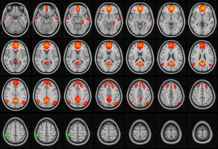 Multiple Concussions Can Disrupt Brain Connectivity in Teens