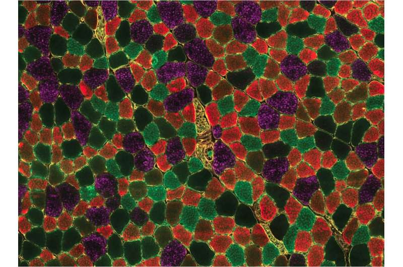 Blocking sphingolipids counteracts muscular dystrophy