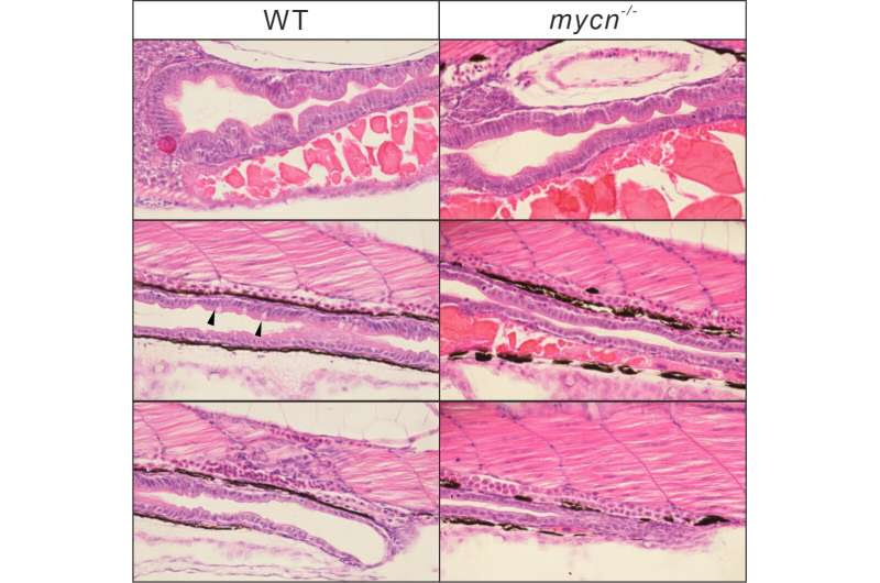 Rare human intestinal disorder is due to reduction in protein synthesis