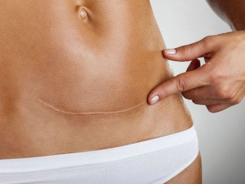 Les cicatrices causées par la césarienne sont des moins désirables.