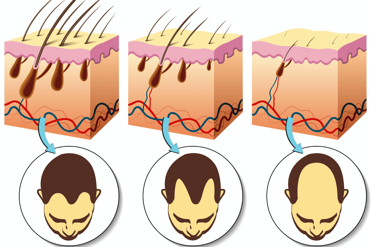 Scientists in China have developed a new microneedle patch that has shown promise in treating hair loss, by taking aim at poor circulation and oxidative stress