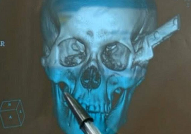 Shocking: Upon arriving at the hospital with the blade still embedded in his head, doctors discovered 39-year-old Juacelo Nunes had severed nerves and veins in his face - injuries that could easily have proved fatal