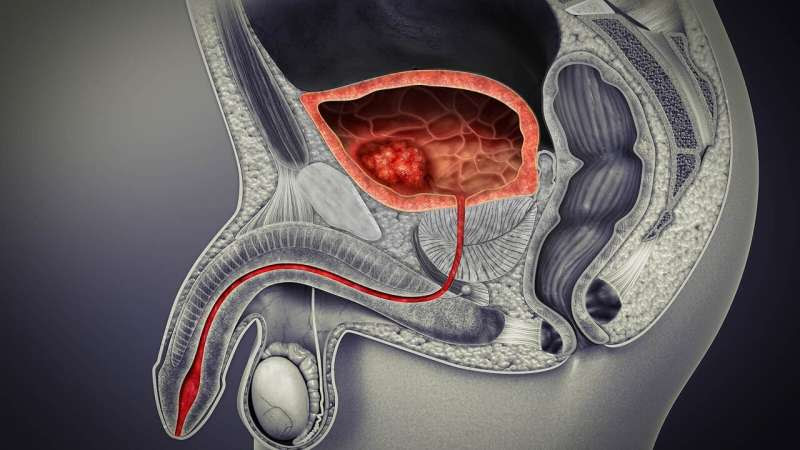 Experimental drug that boosts immunotherapy shows promise in bladder cancer study