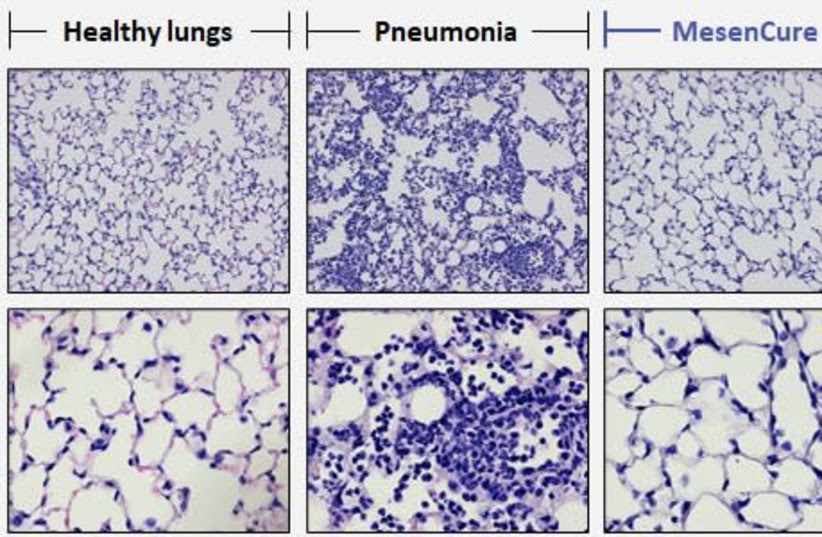 A laboratory image shows a healthy lung, a sick lung and lung treated with MesenCure. (photo credit: Courtesy)