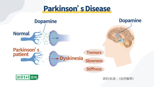 At the Earliest Sign of Parkinson’s Disease, Do This