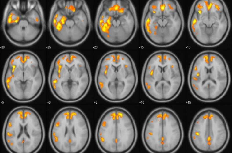 Brainstem atrophy is linked to extrapyramidal symptoms in frontotemporal dementia