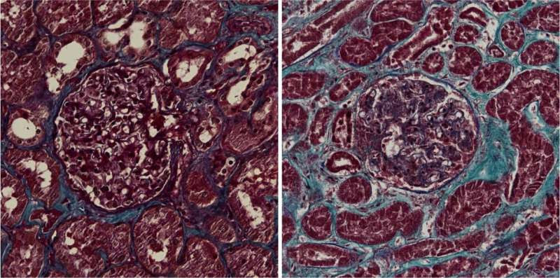 Kidney damage as a result of coronavirus infection