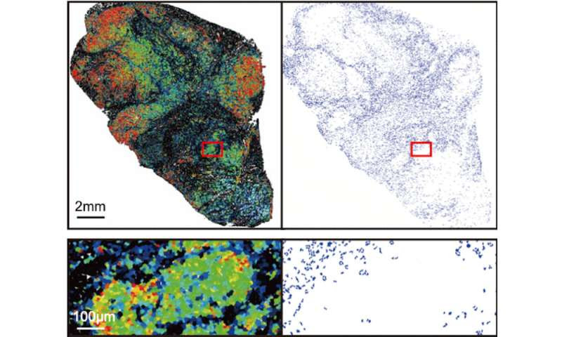 Cancer cells selectively load ‘drones’ to keep T cells from infiltrating tumors