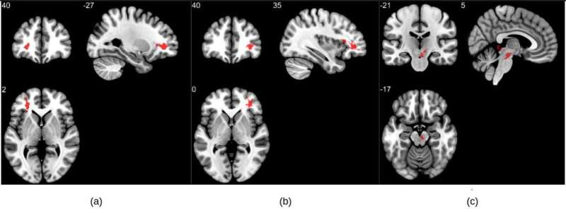 MRI reveals significant brain abnormalities post-COVID