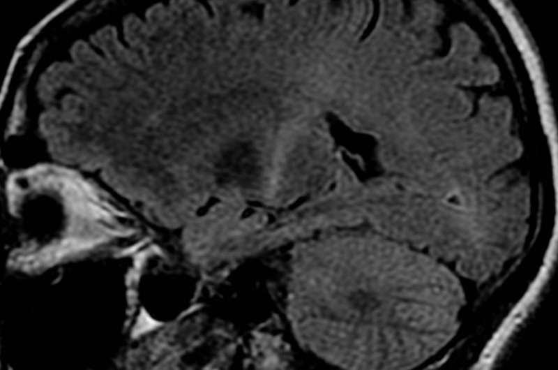 Amyotrophic Lateral Sclerosis