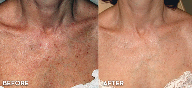 ipl-photofacial-3-sessions-face-chest-3.gif.jpeg