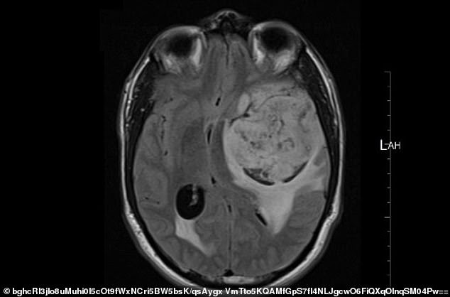 More than 11,000 people are diagnosed with brain tumours each year in the UK and just 14 per cent of adults survive for five years after diagnosis (file image displaying a brain tumour from an unrelated subject)