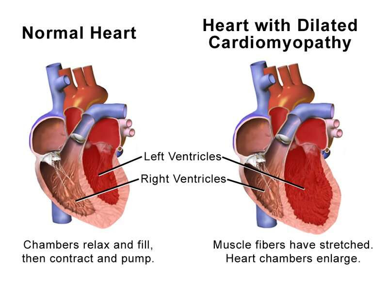 Drug may improve cardiac function in hypertrophic cardiomyopathy