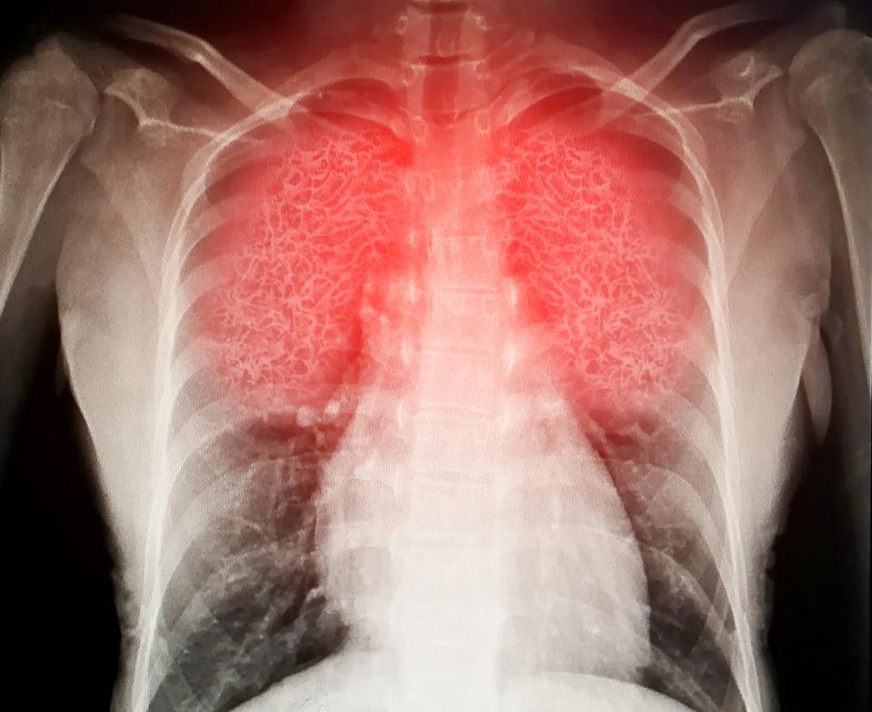 Radiograph of inflamed lungs.