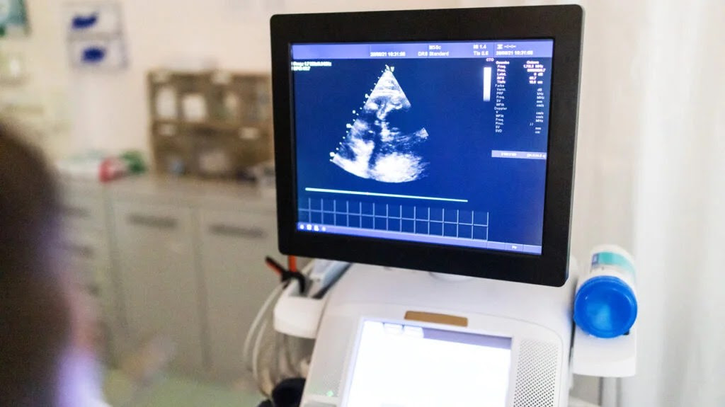 An electrocardiogram (EKG) test showing an image of the heart.