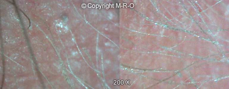 morgellons-hairs