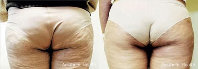 A second patient, who was not in in the study, had carboxytherapy on her backside, causing it to become smaller. Image was taken from the anti-ageing clinic Aesthetic Health, Leeds