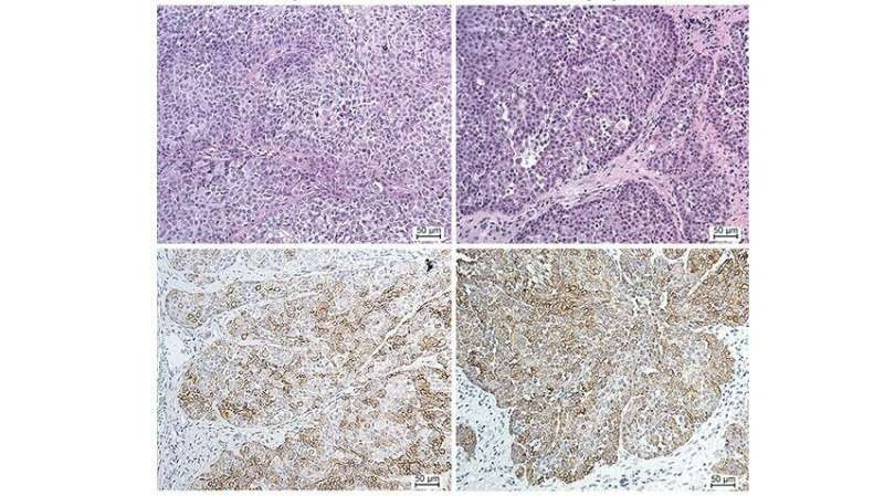 P53 could be key to therapies for salivary gland cancer