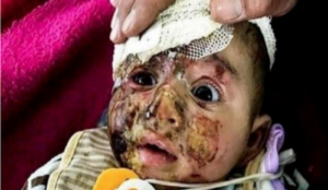 Photo of baby injured in Iraq in 2017 used to claim Israel is committing atrocities now