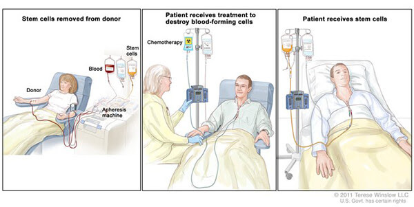 image describes steps of a stem call transplant