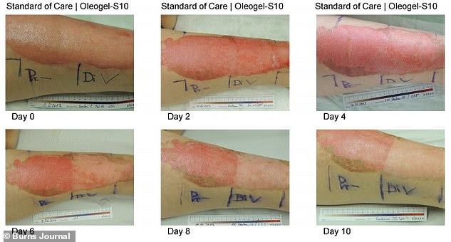 Patients that used the birch-bark gel said it was 'much better'. Picture shows the treatment of the wound over ten days. It is split in half, with the left side being treated with the standard gel and the right side being treated with the birch-bark gel