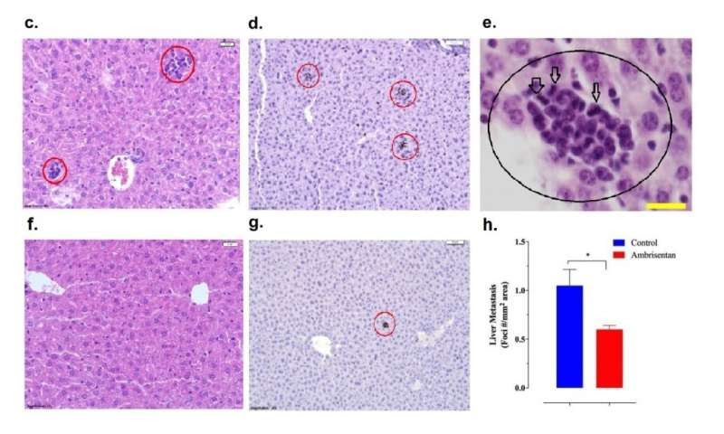 Drug for pulmonary hypertension may become an option against cancer