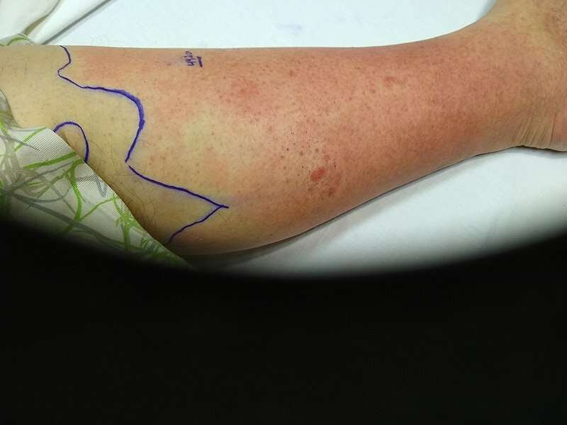 What is cellulitis? A dermatologist explains