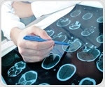 Non-invasive brain stimulation may improve fine motor movement in stroke patients