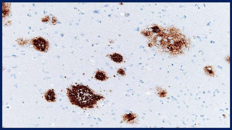 Study says failure to rid amyloid beta protein from brain may lead to Alzheimer's disease