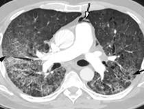 COVID-19 complicado por pneumomediastino em um homem de 61 anos.  Imagens angiográficas de TC de tórax axial mostram uma aparência típica de pneumonia COVID-19, incluindo GGOs difusos e espessamento do septo interlobular (setas pretas).  O ar é representado anterior à artéria pulmonar (seta branca) e adjacente ao tronco da artéria pulmonar e apêndice atrial esquerdo, indicativo de pneumomediastino.  Imagem cortesia de Margarita Revzin et al.  COVID nos pulmões