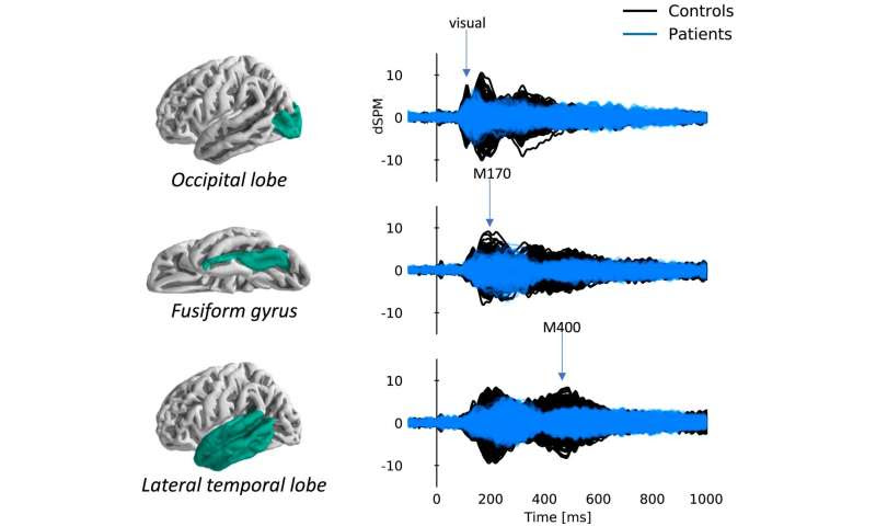 Emerging from the fog: Little understood post-stroke cognitive issues are verified