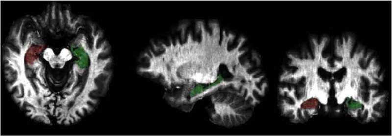 Anxiety and PTSD linked to increased myelin in brain's gray matter