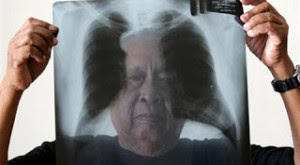 pulmon-asbestos2