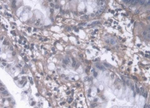 IHC-P analysis of Human Liver cancer tissue with DAB staining, using PIINP Antibody (20 µg/ml) and HRP-conjugated Goat Anti-Rabbit antibody (abx400043, 2 µg/ml)