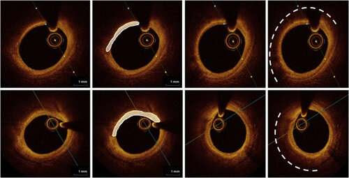 Game-changing new therapy to lower cholesterol and stabilize plaques associated with heart attack