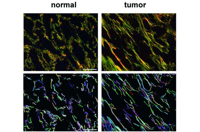 Researchers identify new biomarkers of the most frequent lung cancer