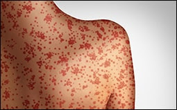 The figure shows a 3D illustration of measles as a skin rash on a patient.