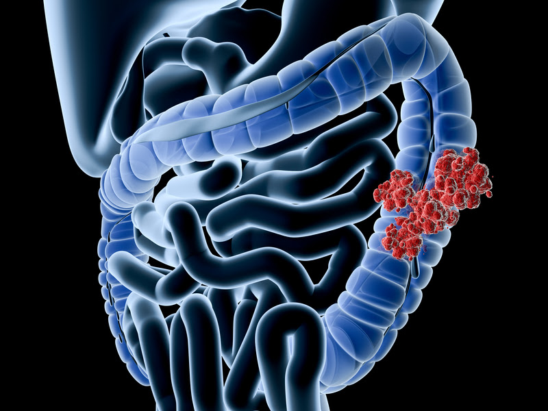 ilustración de cáncer en el colon