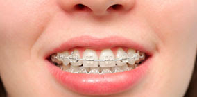 En qué casos necesitas llevar ortodoncia