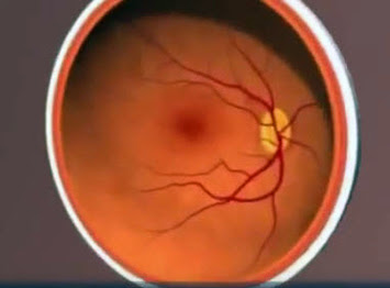 Eye with yellowish deposit under the retina and prominent blood vessels