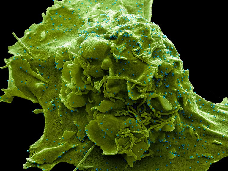 COVID-19 first phase UK variant. Coloured scanning electron micrograph (SEM).