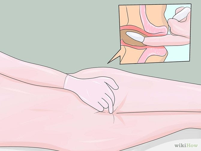 Proper way of inserting cannabis suppository