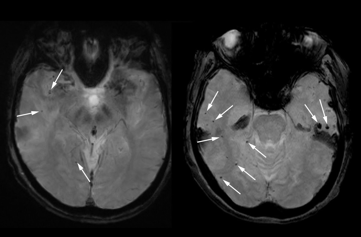 brain scans with arrows pointing to microhemorrhages