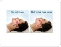 Implantable device receives FDA approval as treatment option for central sleep apnea