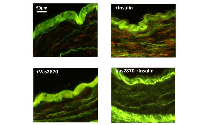 A new strategy to counter insulin damage in coronary artery disease